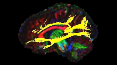 White matter fiber bundles identified using diffusion tensor imaging tractography